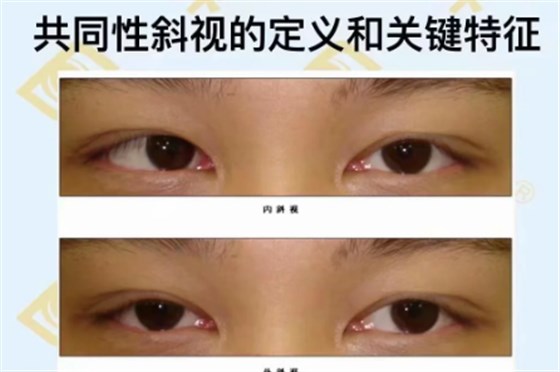 遗传因素:共同性斜视有一定的家族