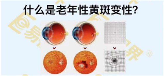 什么是老年性黄斑变性
