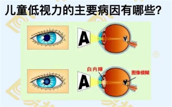 儿童低视力主要病因有哪些