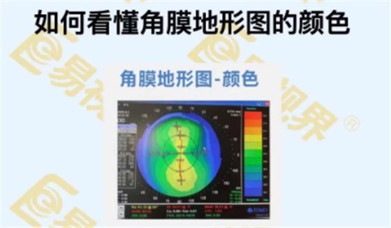 如何看懂角膜地形图的颜色