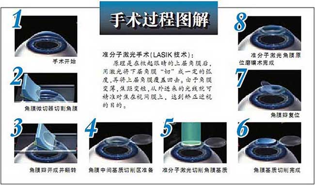 英国政府禁止眼睛激光手术 易视界