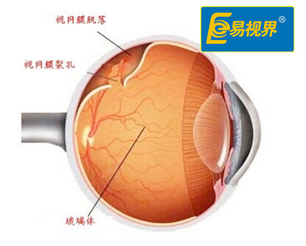 视网膜脱离与哪些因素有关