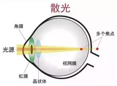易视界护眼专家为您讲解什么是散光