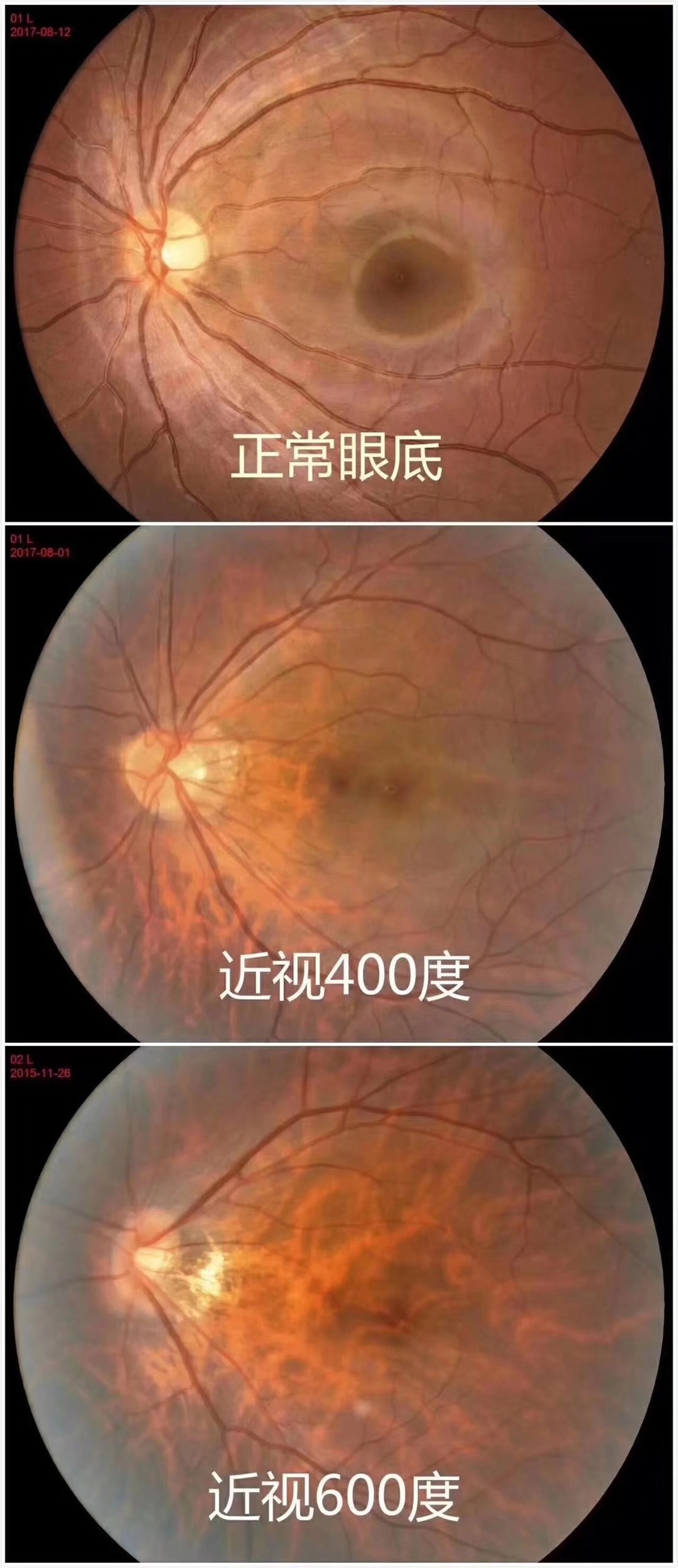 今天给大家讲解一下糖尿病视网膜病变 - 知乎