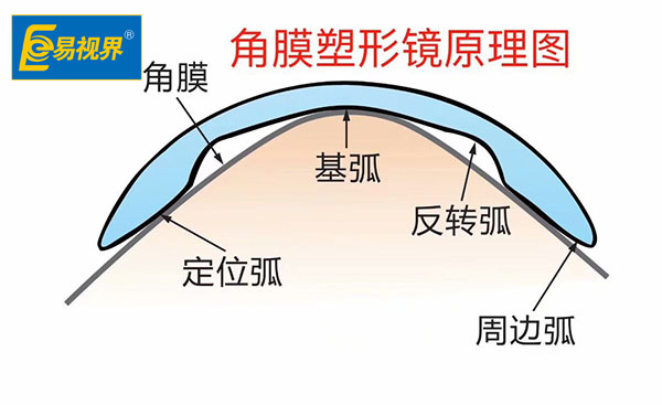 近视以后可否呆角膜塑形镜【易视界眼健康管理机构】