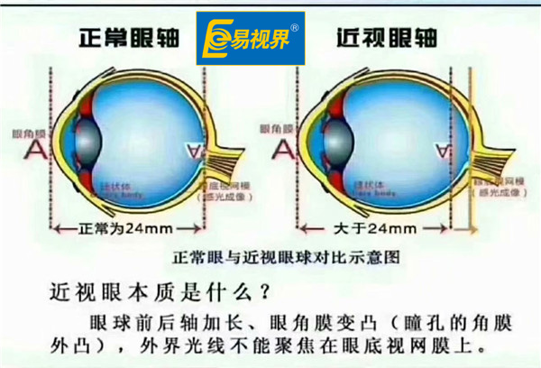 正常眼与近视眼球对比示意图