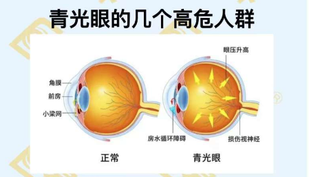 青光眼的几个高危人群？